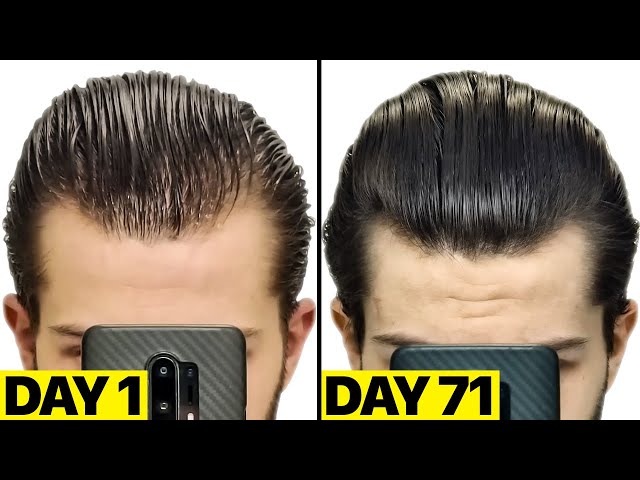 USA IMPORTED Kirkland Minoxidil 5% – Hair Regrowth Solution (60ml) - Image 6